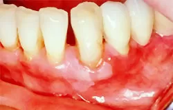 Фото зубов пораженных пародонтитом