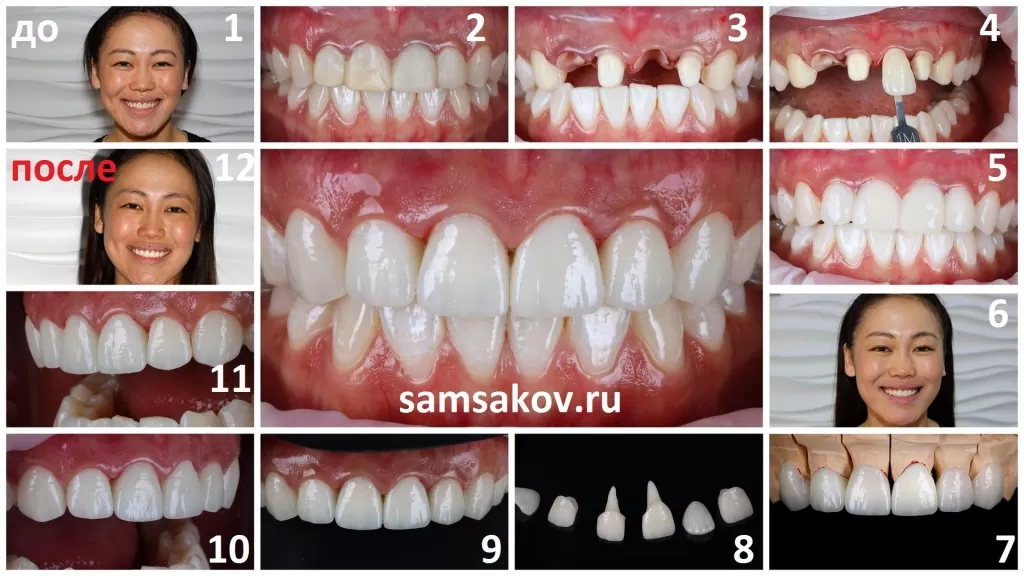 Технология CEREC реально позволяет восстановить зуб за 1-1,5 часа, если от него даже остался один корень