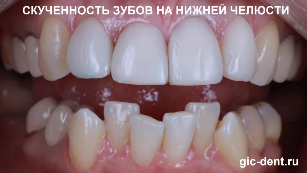 Скученность зубов нижней челюсти