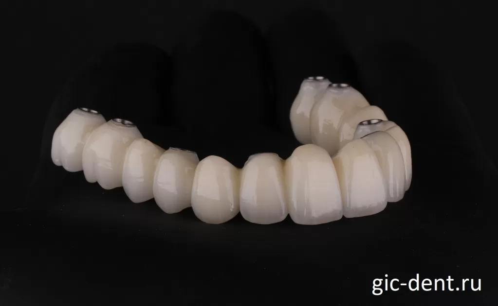 Зубные коронки верхней челюсти изготовлены. Все глазуровано и отполировано. Немецкий Имплантологический центр.