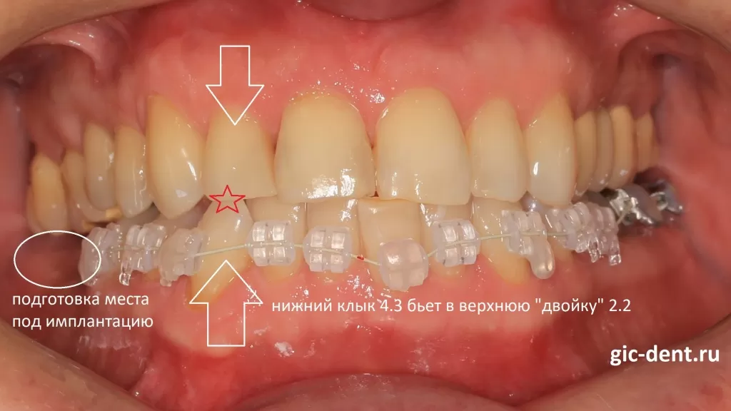 нижний клык 4.3 «бил» в верхнюю «двойку», зуб 1.2 - а это, в дальнейшем, могло спровоцировать проблемы как с пародонтом, так и твердыми тканями самих зубов. Эстетика улыбки пациента. Немецкий имплантологический центр