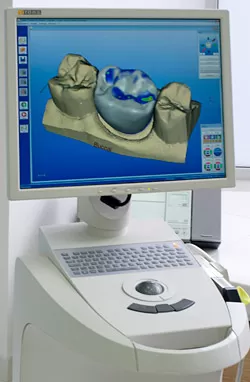  Cerec 3D Протезирование зубов в Немецком имплантологическом центре