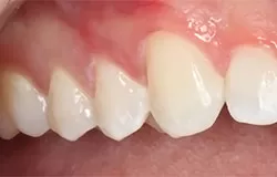 Вид десен и зубов после лечения гингивита 