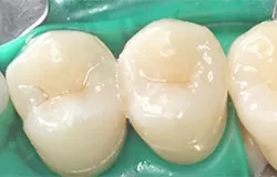 Вылеченные после кариеса зубы