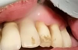 Классическая клиническая картина кисты зуба 