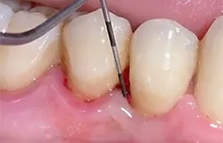 В большинстве случаев лечение периодонтита ограничивается терапевтическими методами, позволяющими сохранить зуб