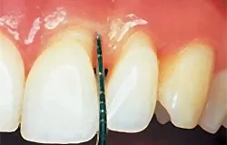 В большинстве случаев лечение периодонтита ограничивается терапевтическими методами, позволяющими сохранить зуб