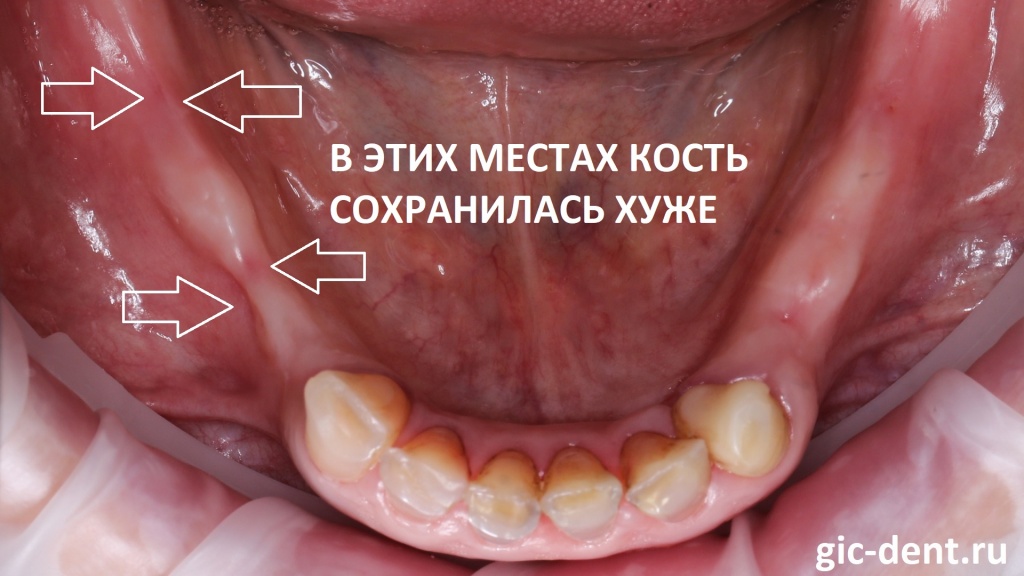 На фото - нижняя челюсть, в правом сегменте кость у пациентки сохранилась хуже из-за прошлых воспалительных процессов, которые когда-то протекали вокруг зубов