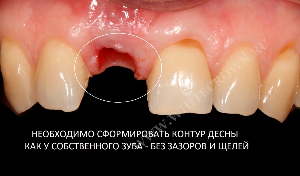 Необходимо сформировать контур десны как у собственного зуба - без зазоров и щелей