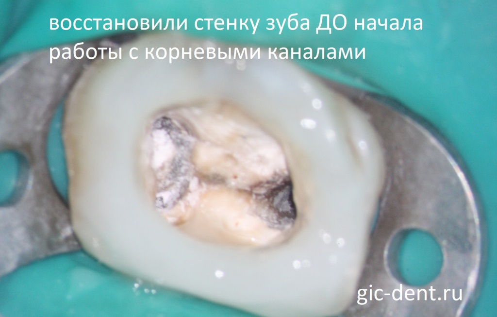 Для начала работы с корневыми каналами стенки зуба должны быть восстановлены. Лечащий врач Меликов Азер Фуадович, немецкий имплантологическиц центр