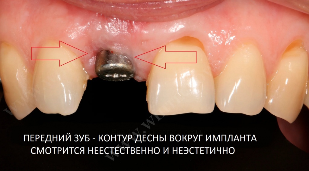 Контур десны вокруг импланта переднего зуба смотрится неестественно и неэстетично