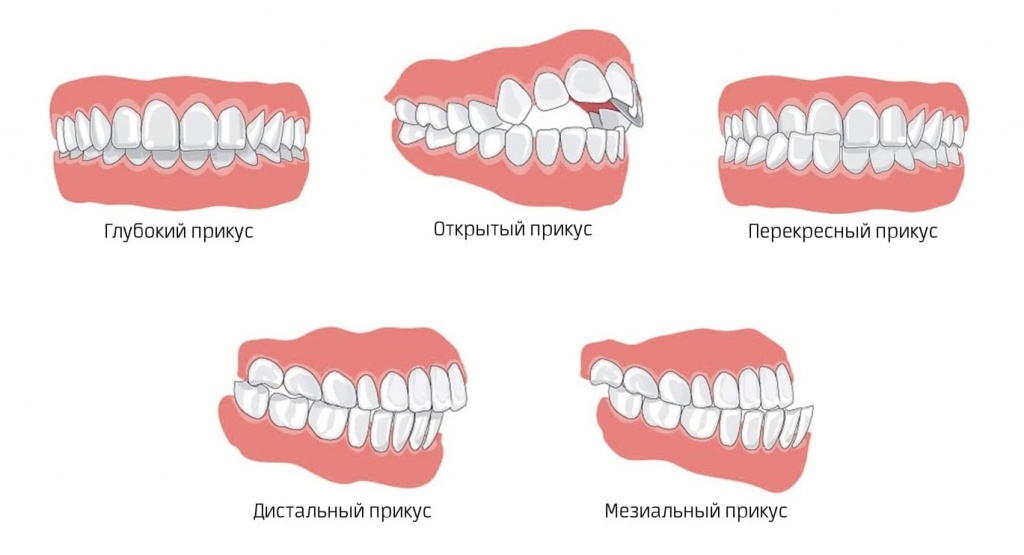 Ортодонтическое лечение патологической стираемости зубов thumbnail
