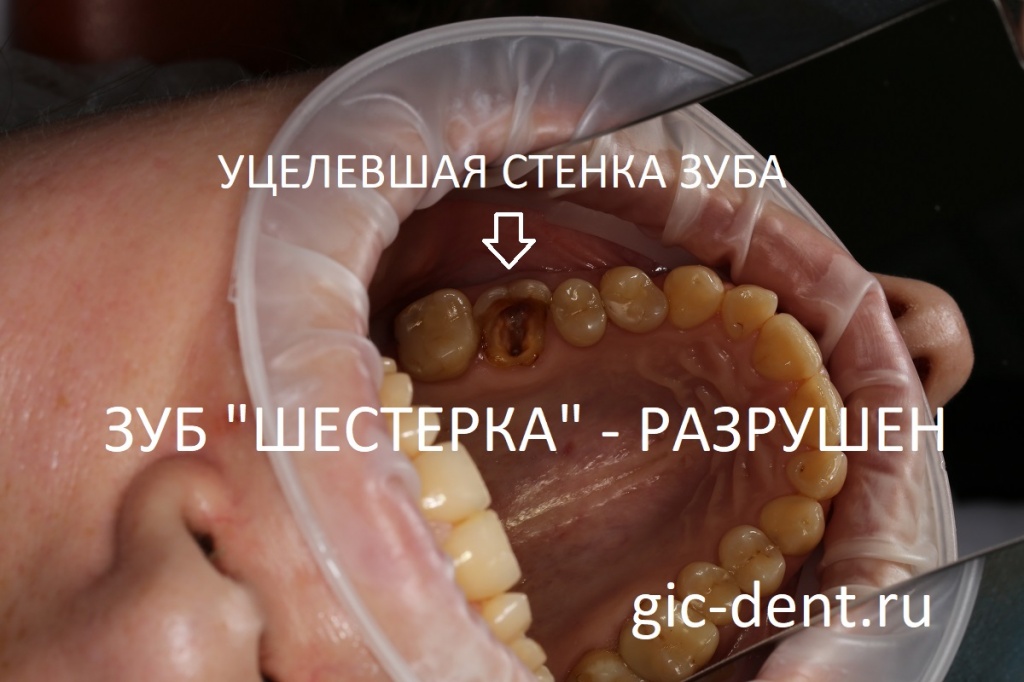 Лечение шестого нижнего зуба thumbnail