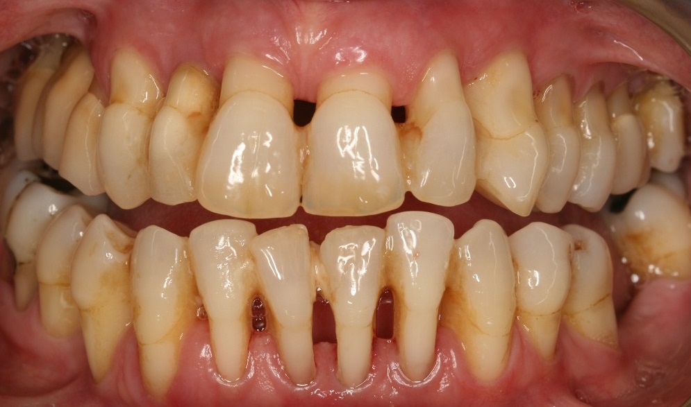 Пародонтит удаление зуба лечение thumbnail