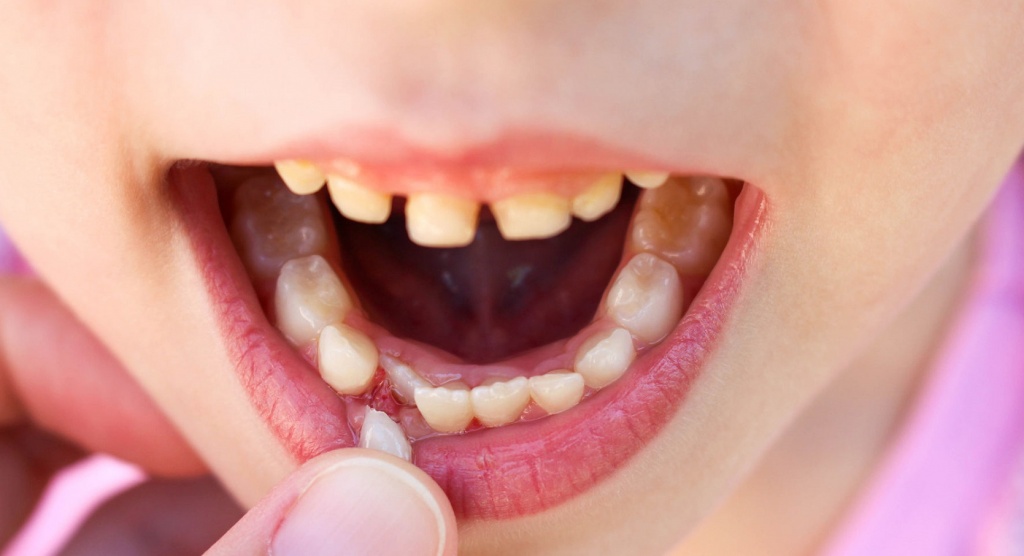 Ортодонтическое лечение повышенной стираемости зубов thumbnail