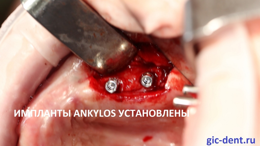 только что установленные новые импланты Анкилоз в области зубов 1.5 и 1.6 в лунках ранее удаленных проблемных имплантов Альфа Био.