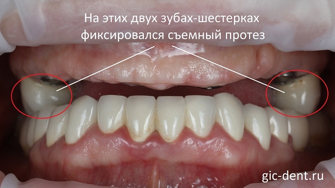 Протезирование при полном отсутствии зубов с опорой на импланты
