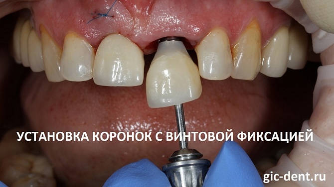 Имплантация зубов верхней челюсти с восстановлением зоны улыбки и жевательных единиц