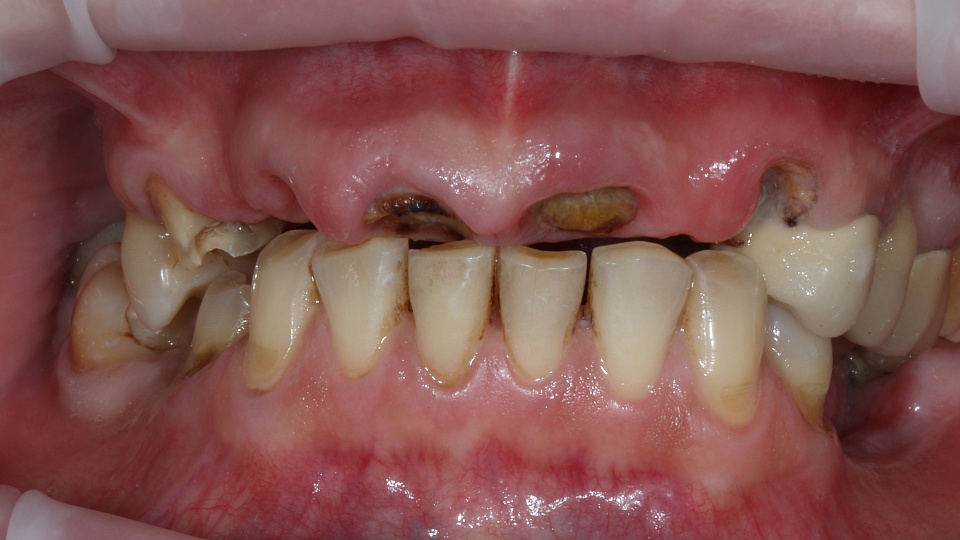 Адентия врожденное отсутствие зуба: симптомы, признаки, диагностика и лечение