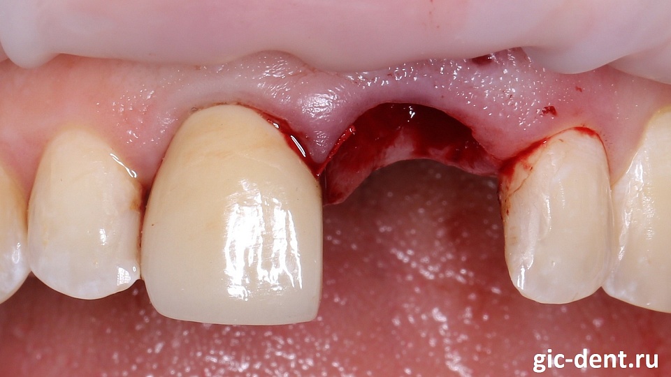 Временное протезирование переднего зуба с одномоментным удалением и имплантацией