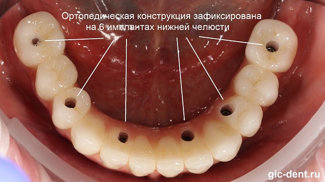 Зубные протезы на имплантах – современные методы восстановления зубов