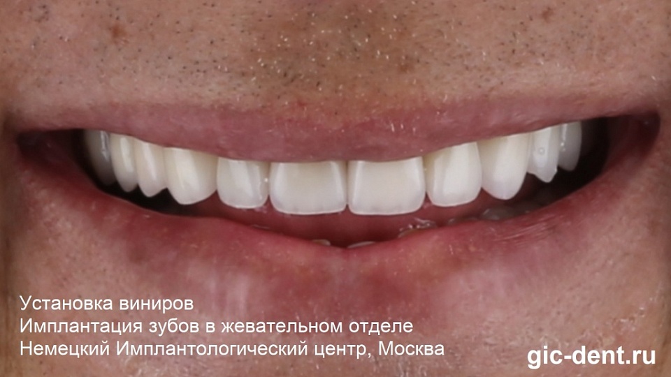 Пример как можно поставить виниры, если нет нескольких зубов