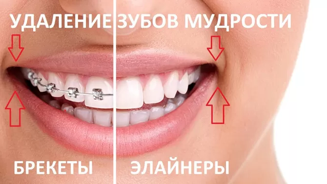 Удаление зубов мудрости при исправлении прикуса
