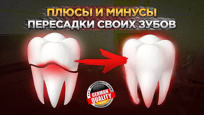 Плюсы и минусы трансплантации собственных зубов - Немецкий имплантологический центр, Москва