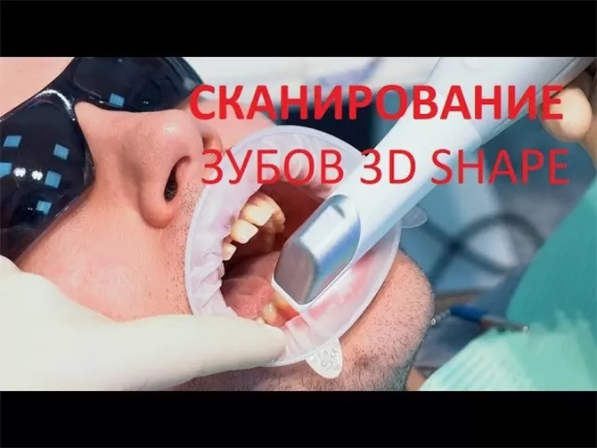 Интраоральное сканирование зубов сканером 3D Shape