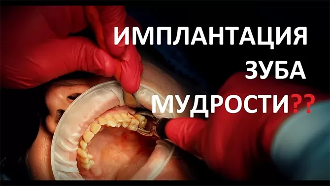 Имплантация зубов мудрости или восьмерок