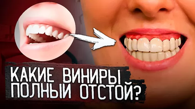 Композитные виниры лучше не ставить, меняем их на керамические виниры. Реставрация зубов в Москве.