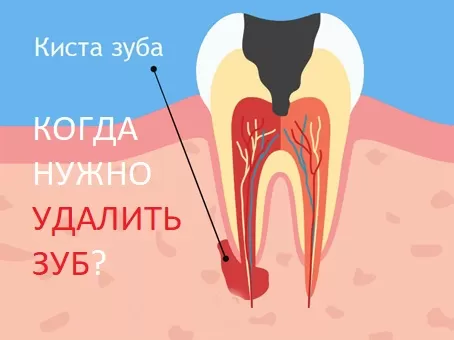 Что такое киста зуба, причины появления, симптомы