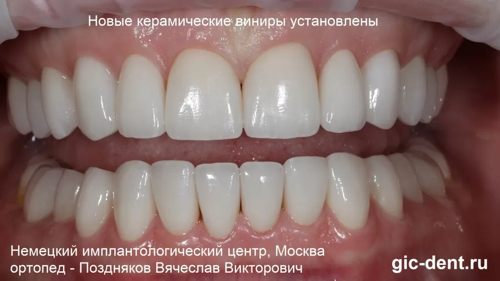 Трещины на эмали зубов: причины и лечение: статьи клиники Оксфорд Медикал Киев