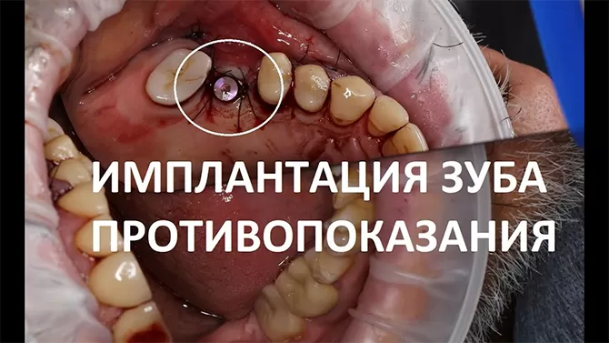 Противопоказания к имплантации зубов. Немецкая имплантология в Москве.