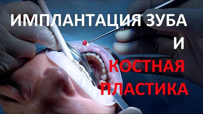 Имплантация зуба и костная пластика. Рекомендации хирурга.