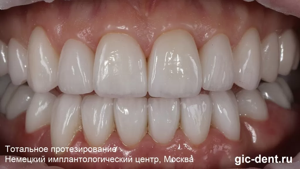 Самые красивые зубы и самый лучший отзыв пациентки. Немецкий имплантологический центр, Москва