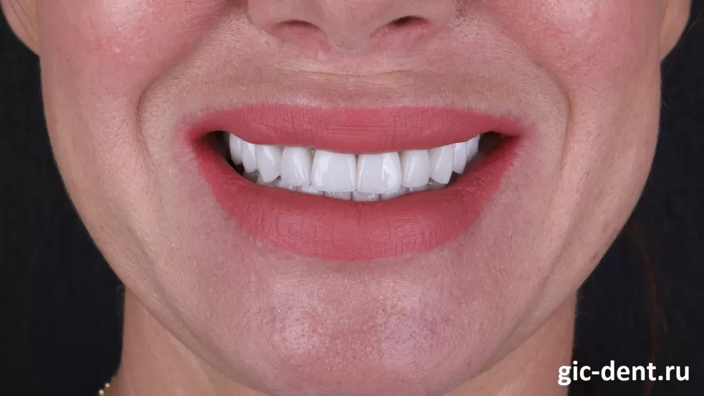 Мощная красота и восстановленная эстетика зубов у нашей пациентки, не находите?