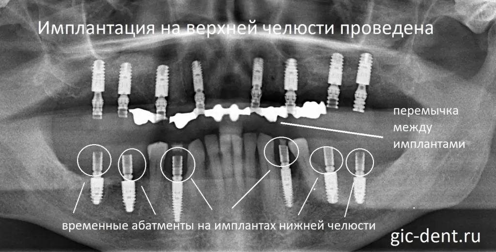 После имплантации верхней челюсти - установлено 8 Ankylos с армированием. Немецкий имплантологический центр