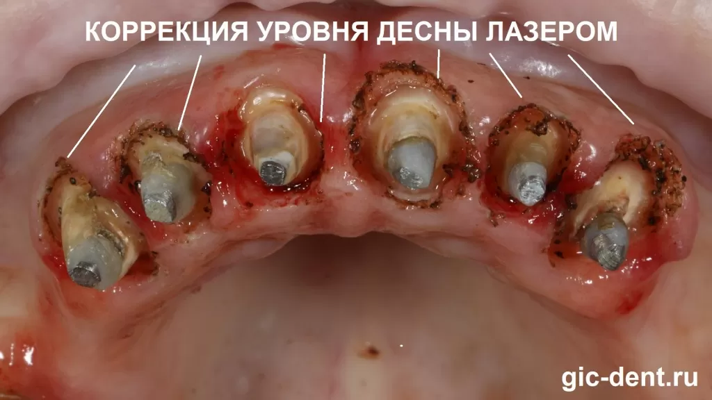 Коррекция уровня десны лазером, открыта поддесневая часть зуба для фиксации на нее коронки.