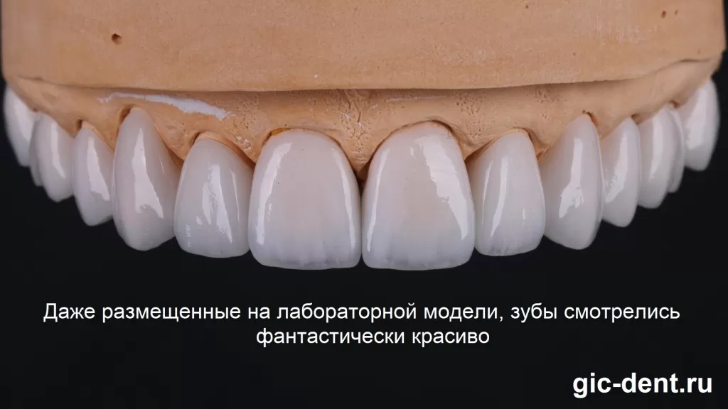 Так выглядел верхний ряд зубов на лабораторной модели. Красота и совершенство. Немецкий имплантологический центр, Москва 