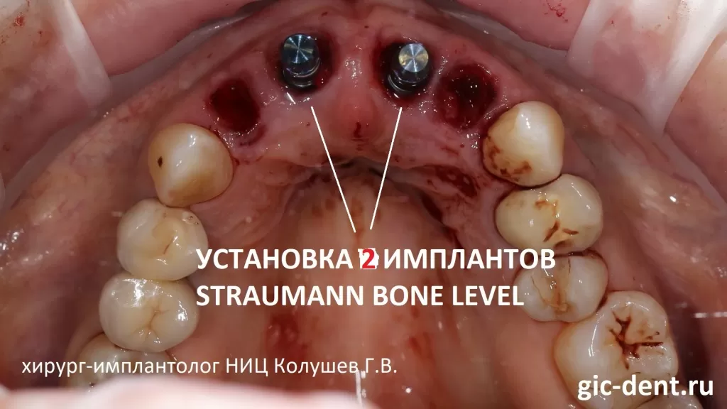 Установка 2 имплантов Штрауманн в позиции центальных резцов при имплантации и протезировании 4 передних верхних зубов