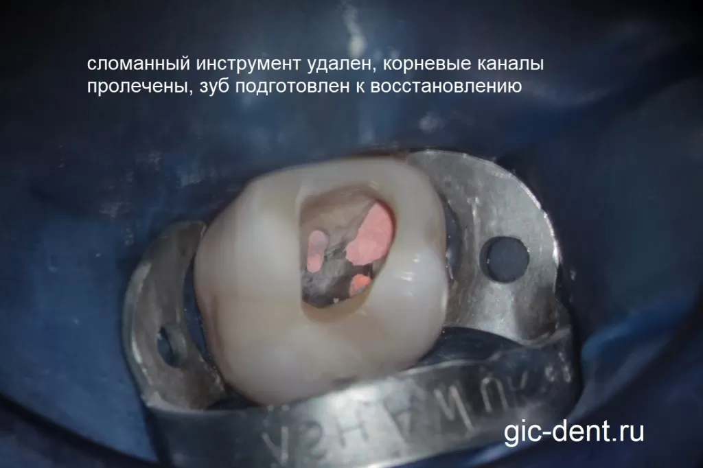 Вид полости зуба после обтурации системы корневых каналов и подготовки полости зуба под восстановление постоянной пломбой 