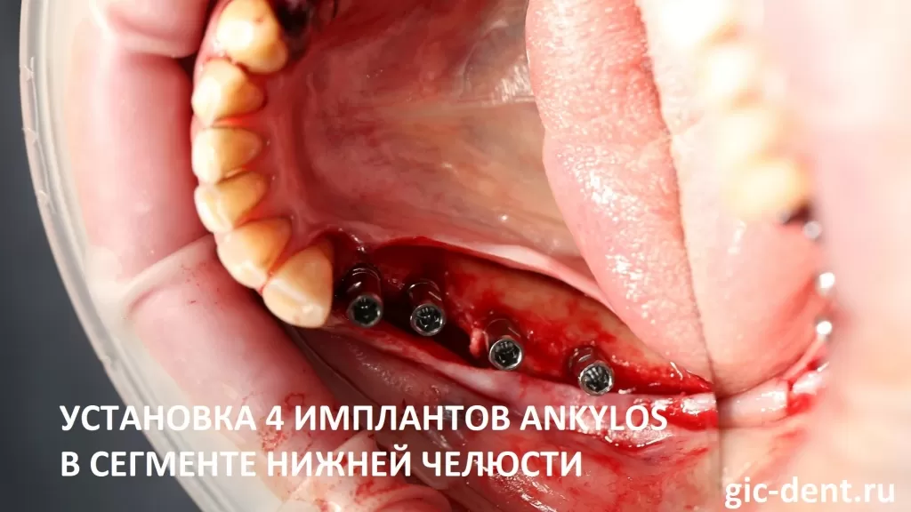 Установка 4 имплантов Ankylos в жевательном сегменте нижней челюсти. Операцию проводит хирург-имплантолог Дахкильгов Магомед Уматгиреевич