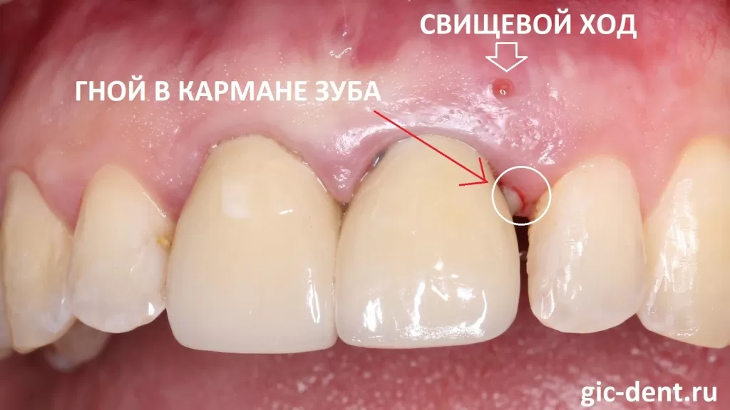 Что происходит с десной после удаления зуба?
