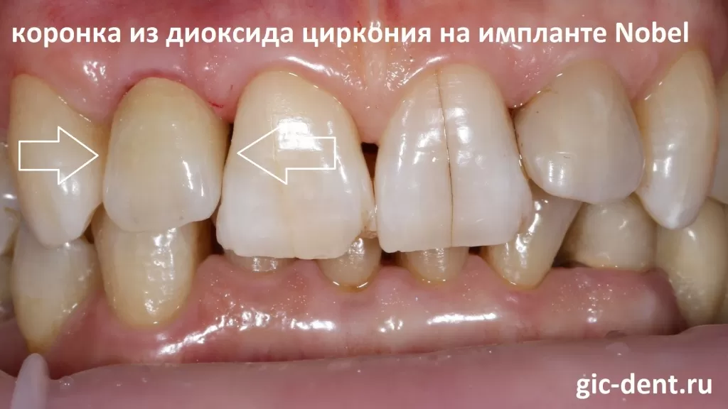 Пациентка хотела абсолютную естественность нового зуба, который ничем бы не выдавал свое искусственное происхождение. 