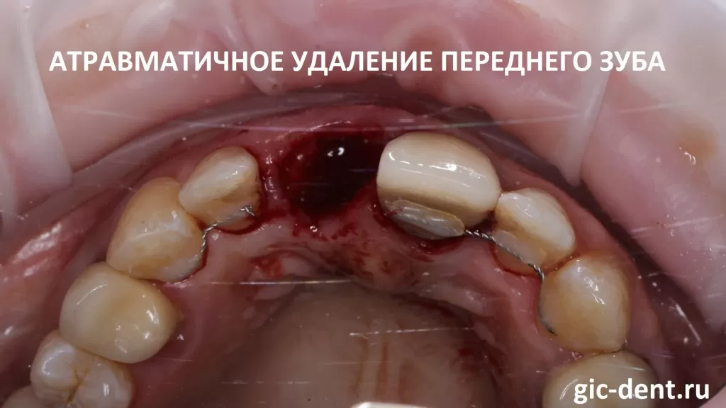 Атравматичное удаление переднего верхнего зуба. Хирург-имплантолог Дахкильгов Магомед Уматгиреевич