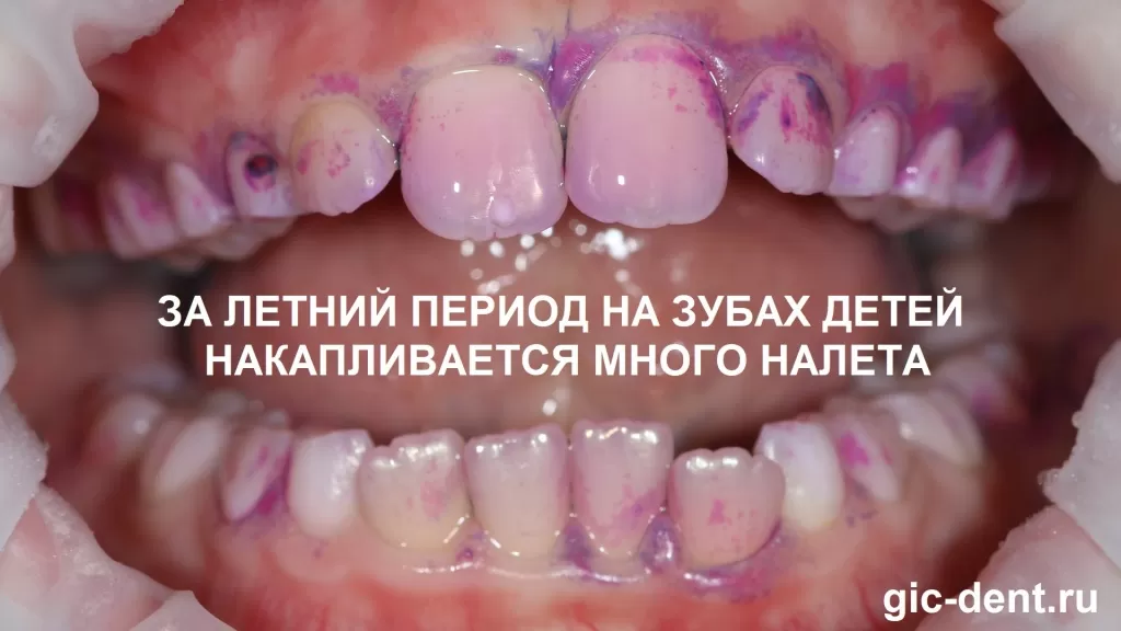 За летний период на зубах детей накапливается большое количество зубного налета