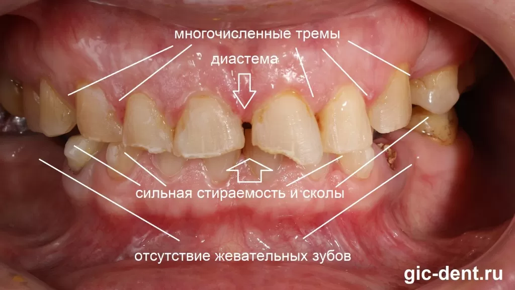 Зубы после 50 лет нужно обязательно приводить в порядок