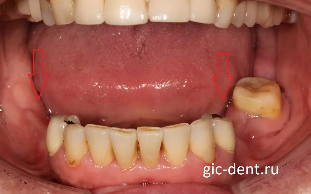 Частичная потеря зубов, соответственно - частичная адентия