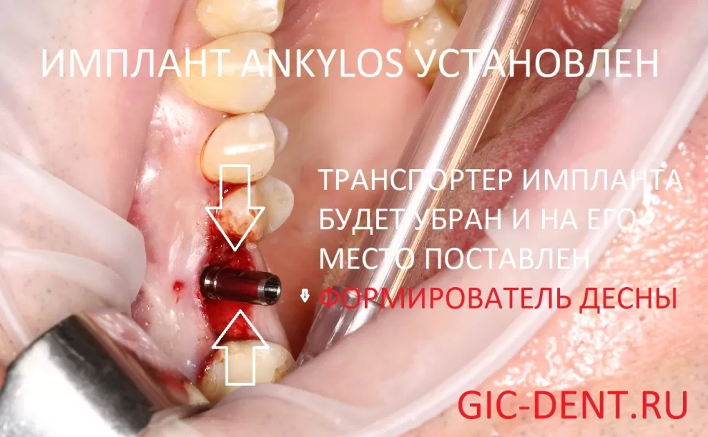 Имплантат Ankylos установлен в процессе проведения закрытого синус лифтинга